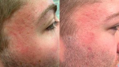 acne scar removal with plasma pen