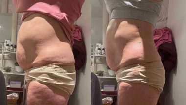 Non-invasive Lipo on the tummy