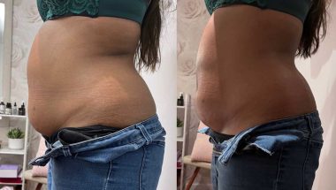 Non-invasive Lipo