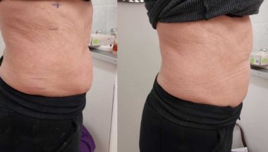 Non-surgical Lipo on the tummy