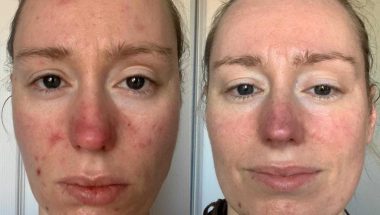 Rosacea treatment using